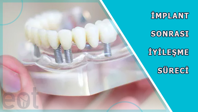 implant-sonrasi-iyilesme