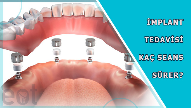 kac-seans-implant
