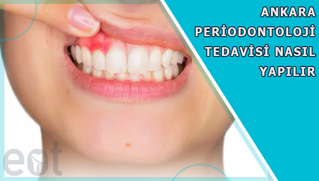 Ankara-Periodontoloji-Tedavisi