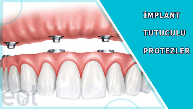 implant-Tutuculu-Protezler