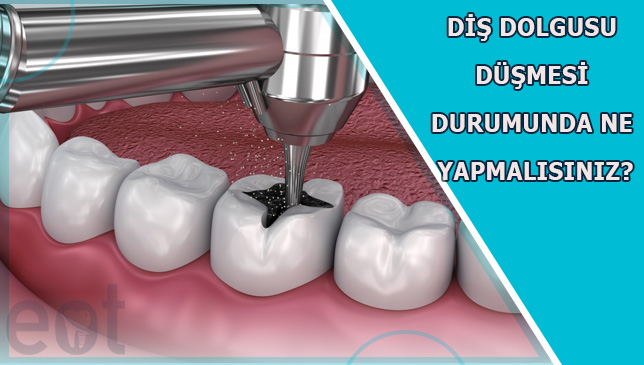 dis-dolgusu-dusmesi
