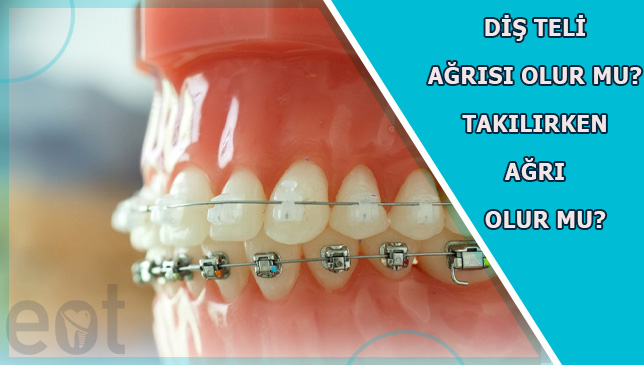 Dis-teli-agrisi