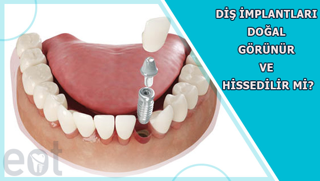 Diş İmplantları Doğal Görüntü