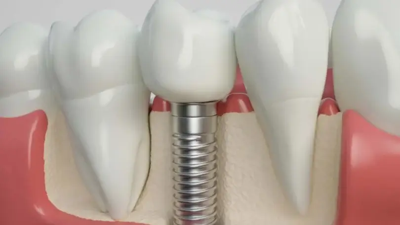 Başarısız İmplant Belirtileri ve Nedenleri
