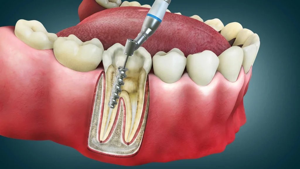 Ankara Endodonti Tedavisi, Kanala Tedavisi Ankara, Fiyatları