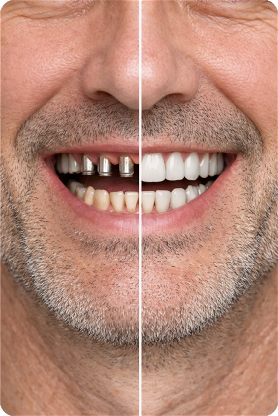 Dental İmplant